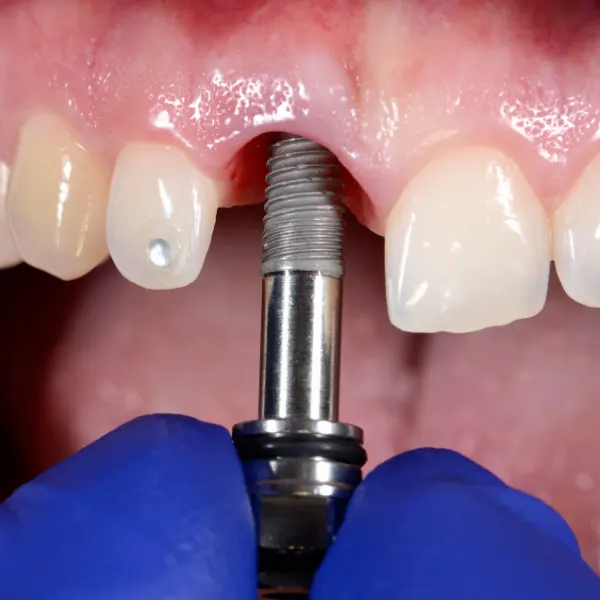 Mantenimiento y seguimiento de implantes dentales en Córdoba