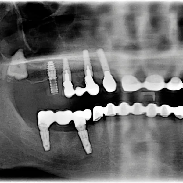 Control radiográfico de implantes dentales en Córdoba