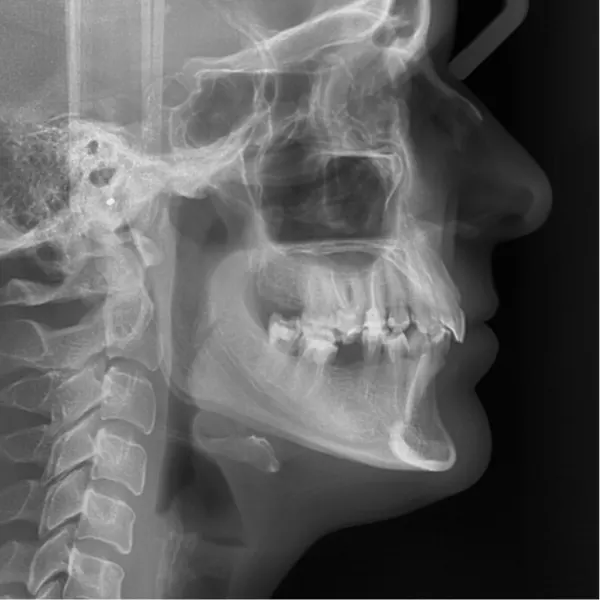 Estudio cefalométrico para ortodoncia en Córdoba