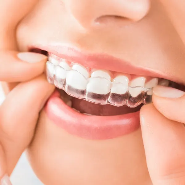 Invisalign en Córdoba